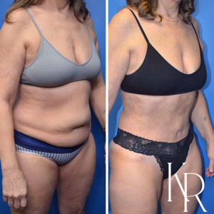Tummy tuck before and after photo, front view