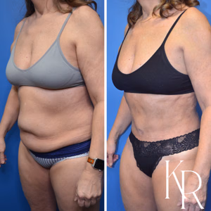 Tummy tuck before and after photo, oblique view