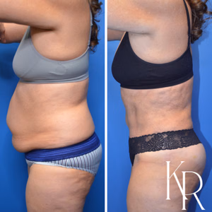 Tummy tuck before and after photo, side view