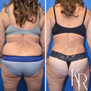 Tummy tuck before and after photo, rear view