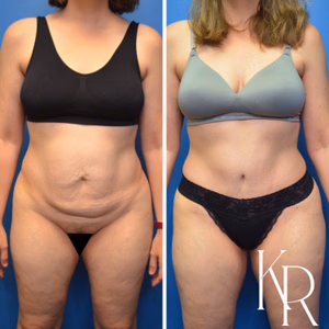 Tummy tuck before and after photo, front view
