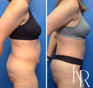Tummy tuck before and after photo, side view