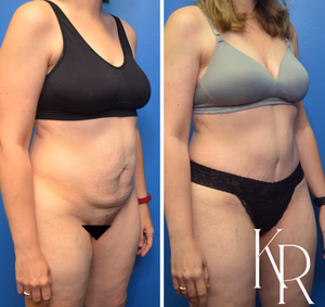 Tummy tuck before and after photo, front view