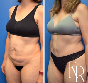Tummy tuck before and after photo, oblique view
