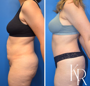 Tummy tuck before and after photo, side view