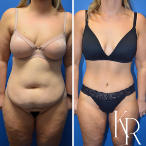 Tummy tuck before and after photo, front view