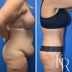 Tummy tuck before and after photo, side view