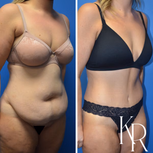 Tummy tuck before and after photo, front view