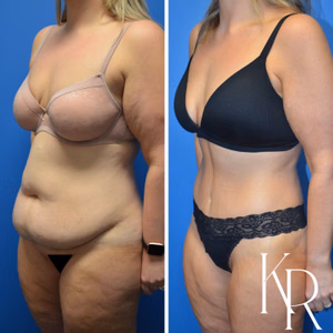 Tummy tuck before and after photo, oblique view