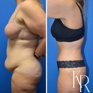 Tummy tuck before and after photo, side view