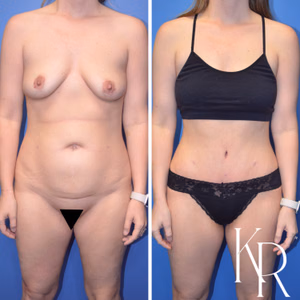 Tummy tuck before and after photo, front view