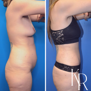 Tummy tuck before and after photo, side view