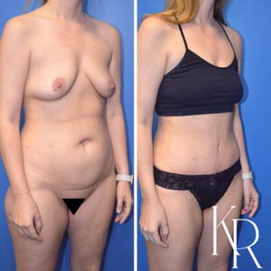 Tummy tuck before and after photo, front view