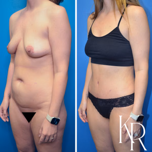 Tummy tuck before and after photo, oblique view