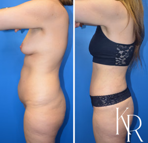 Tummy tuck before and after photo, side view