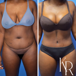 Tummy tuck before and after photo, front view