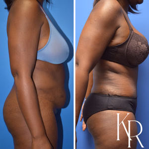 Tummy tuck before and after photo, side view