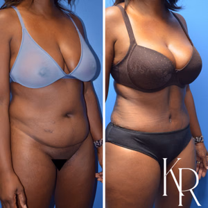 Tummy tuck before and after photo, front view