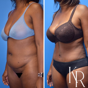 Tummy tuck before and after photo, oblique view