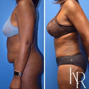 Tummy tuck before and after photo, side view