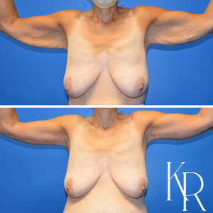 Arm lift before and after photo, front view