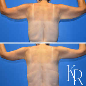 Arm lift before and after photo, rear view