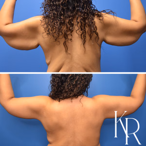 Arm lift before and after photo, rear view