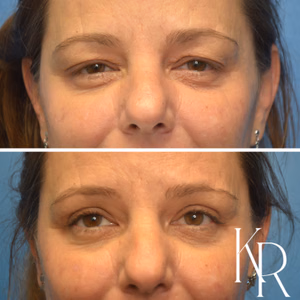Eyelid surgery before and after photo, front view