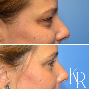 Eyelid surgery before and after photo, side view