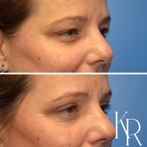 Eyelid surgery before and after photo, side view