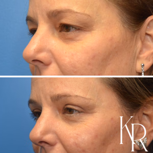 Eyelid surgery before and after photo, side view