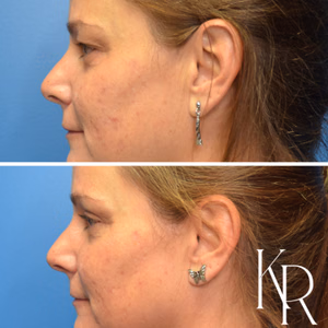 Eyelid surgery before and after photo, side view