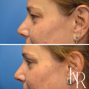 Eyelid surgery before and after photo, front view