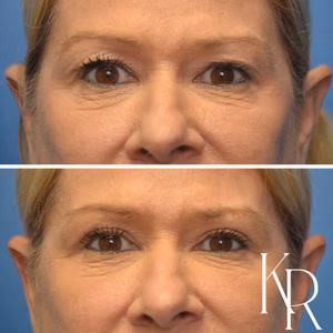 Eyelid surgery before and after photo, side view