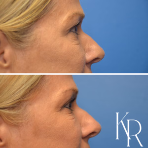 Eyelid surgery before and after photo, side view