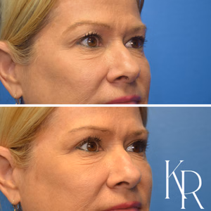 Eyelid surgery before and after photo, side view