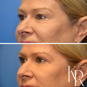 Eyelid surgery before and after photo, side view