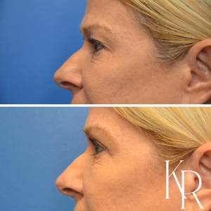 Eyelid surgery before and after photo, side view