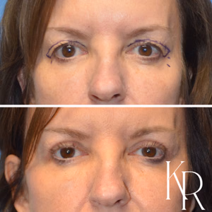 Eyelid surgery before and after photo, front view