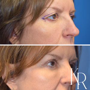 Eyelid surgery before and after photo, side view