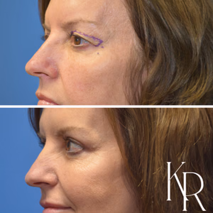 Eyelid surgery before and after photo, close-up view