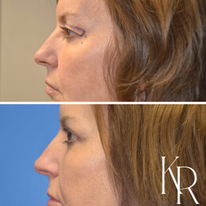 Eyelid surgery before and after photo, close-up view