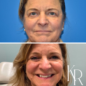 Eyelid surgery before and after photo, front view