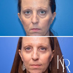 Eyelid surgery before and after photo, front view