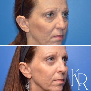 Eyelid surgery before and after photo, side view