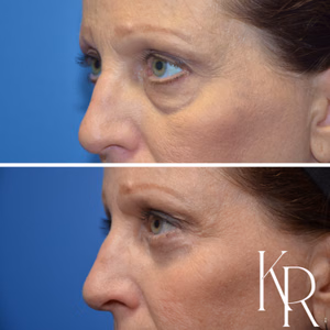 Eyelid surgery before and after photo, close-up view