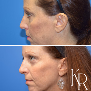 Eyelid surgery before and after photo, side view
