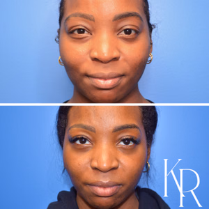 Eyelid surgery before and after photo, front view