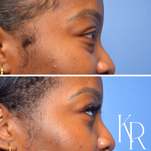 Eyelid surgery before and after photo, side view
