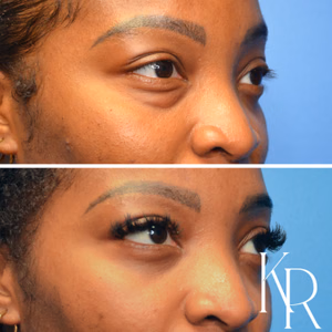 Eyelid surgery before and after photo, side view